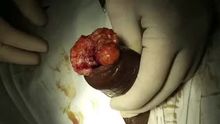 Worms inside of a penis