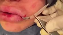 Bolted on lips surgery lip implants
